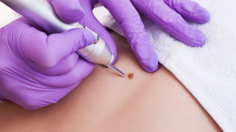 Skin Tag Removal